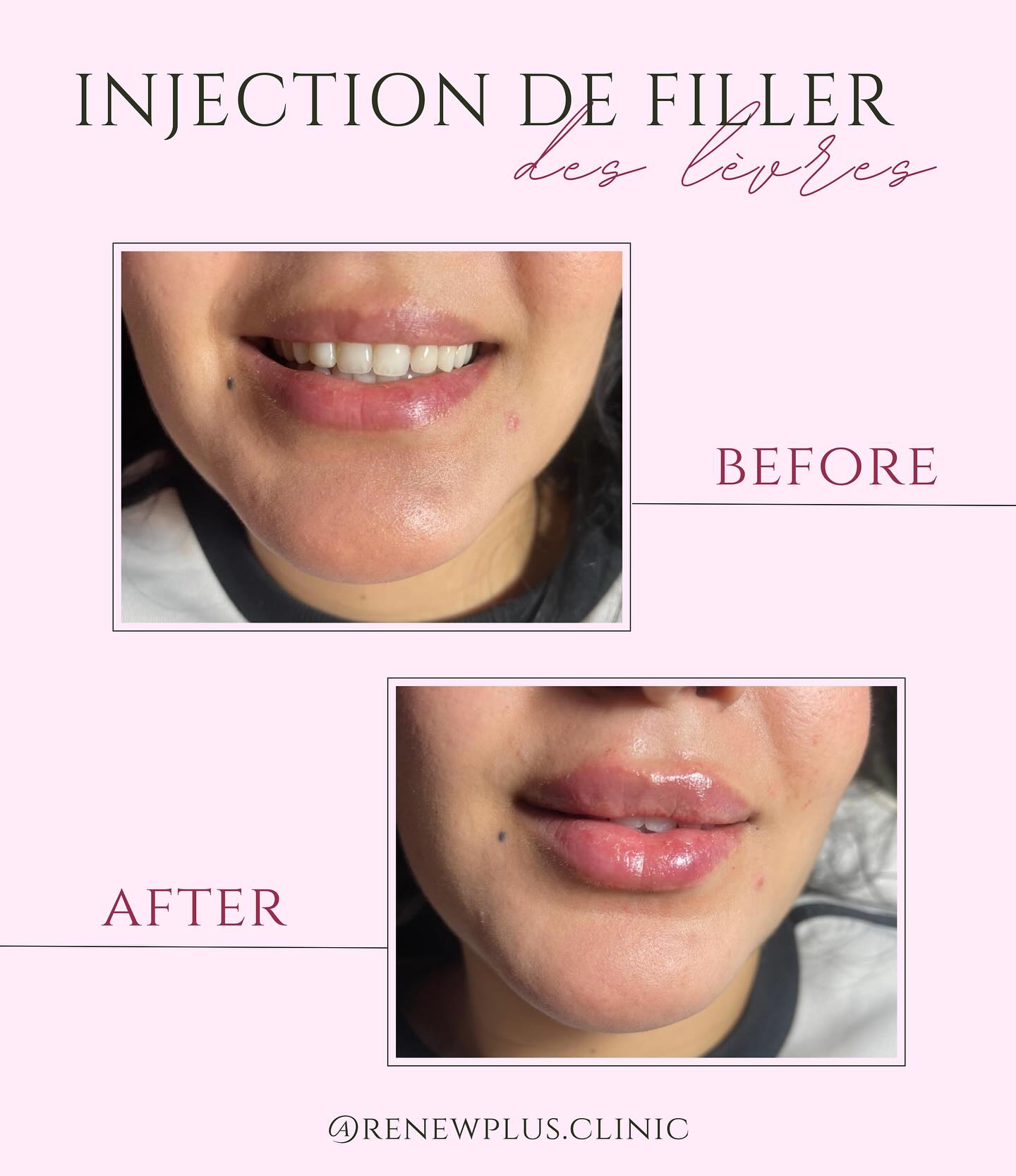 Avant Après filler lèvres