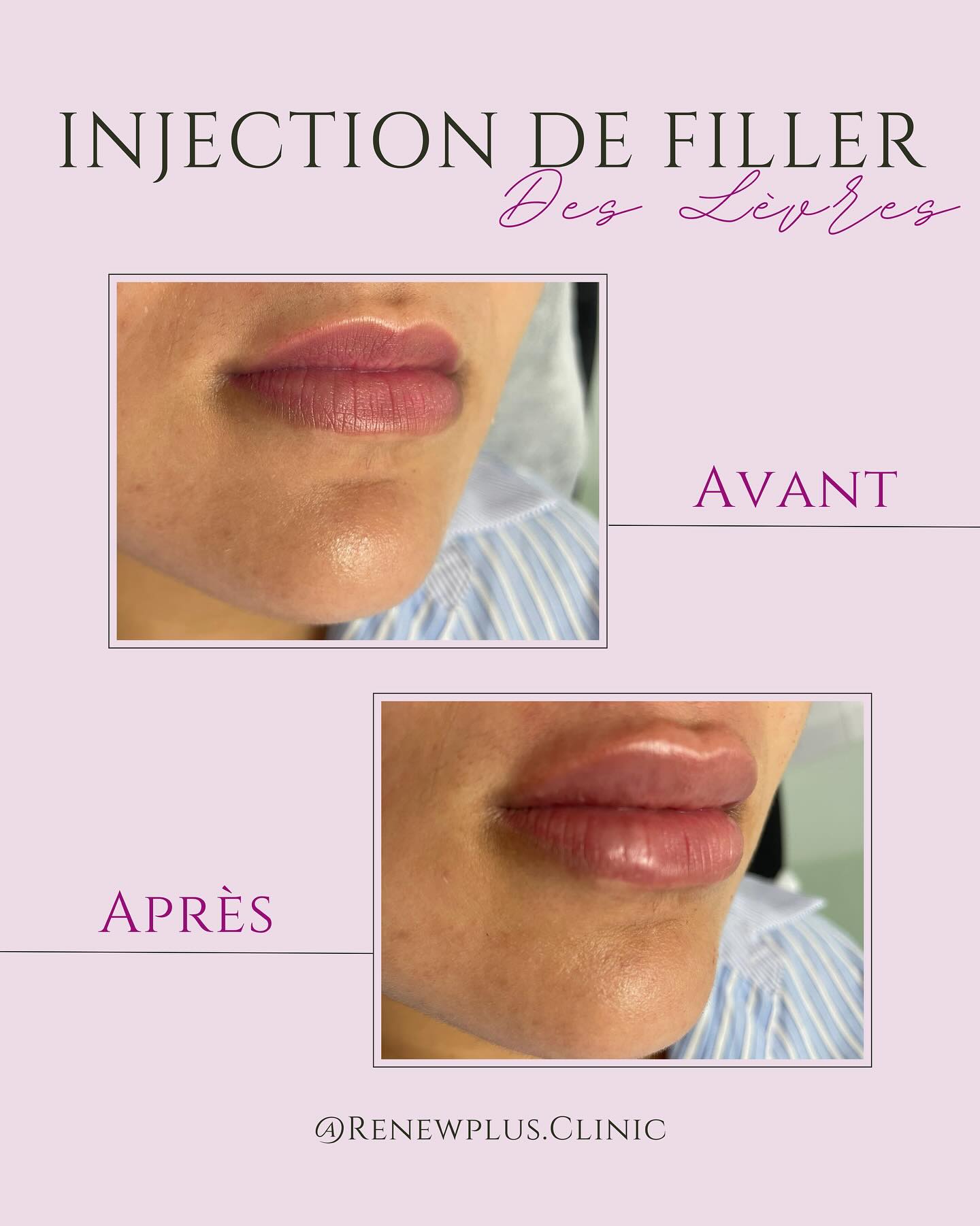 Avant Après filler lèvres naturel