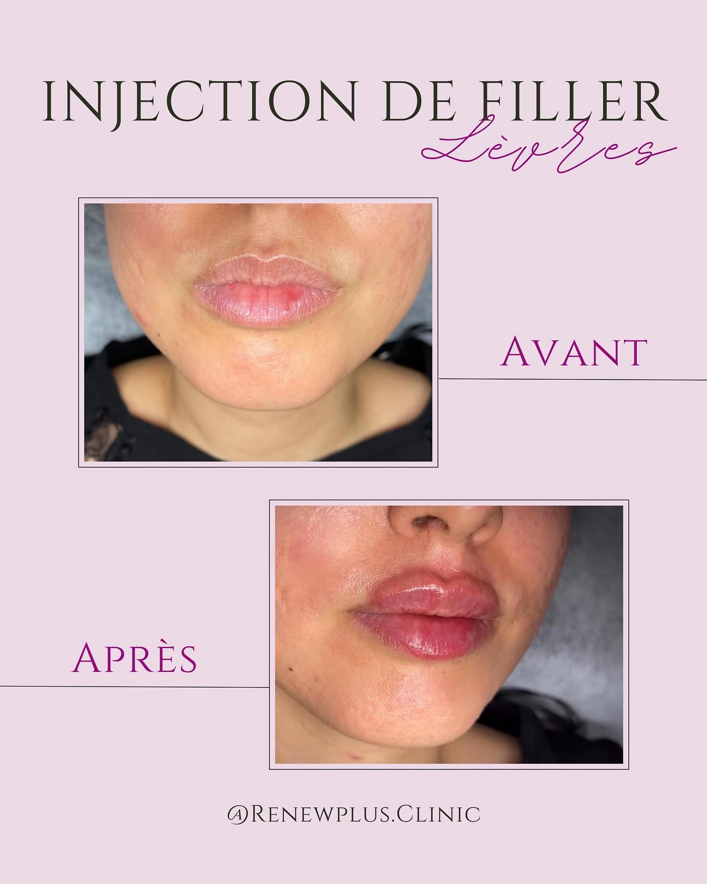 Avant Après filler lèvres 4