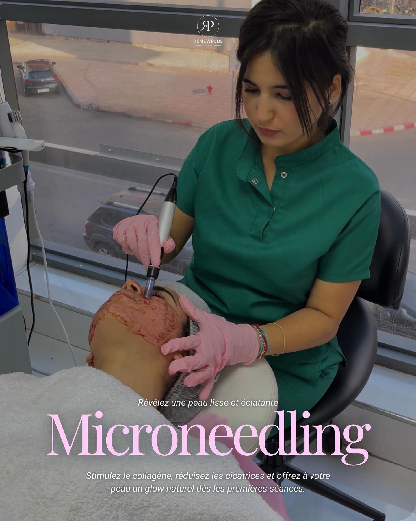 Microneedling RenewPlus Clinic